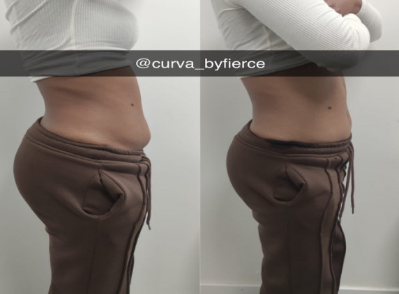 60% DE RÉDUCTION SUR 2 SÉANCES DE SOIN LIPOCAVITATION ET RADIOFREQUEENCE CHEZ CURVAS BY FIERCE